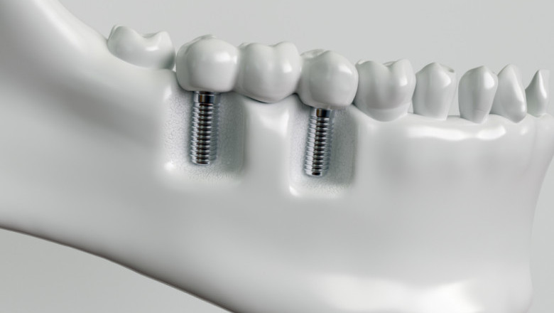 Find the Best Worcester Dental Implants | Excellence-In-Dentistry