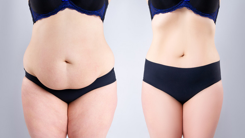 ¿Qué implica el procedimiento de abdominoplastia?