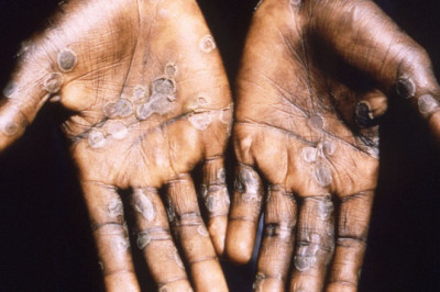 Monkeypox in Africa