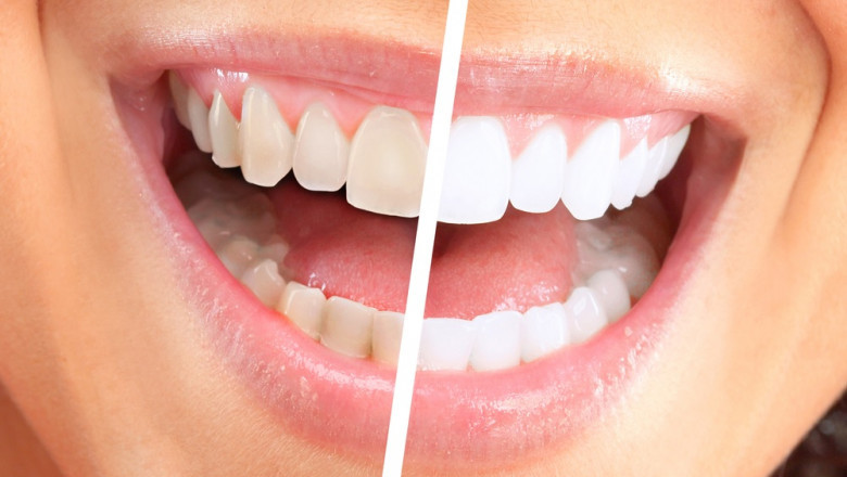 PRECAUTIONS AFTER TEETH WHITENING