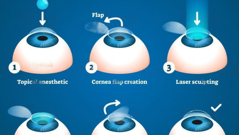 What is Laser vision correction?