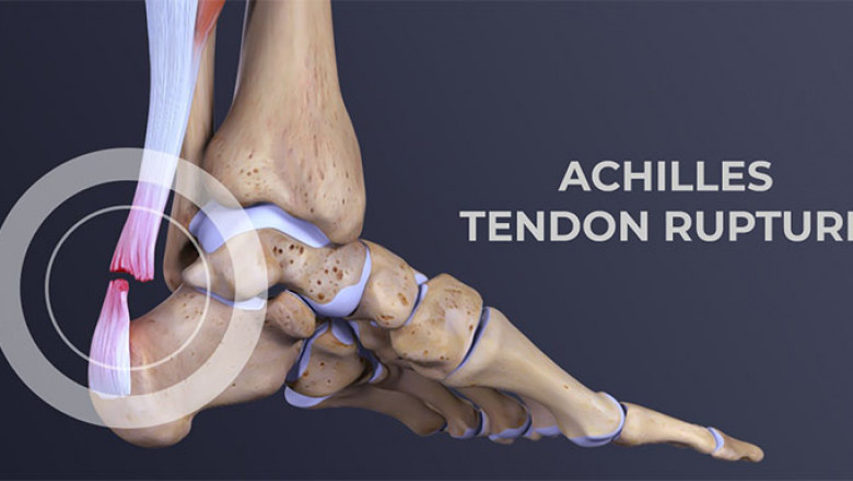 Achilles tendon rupture - treatment, surgery