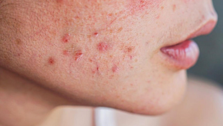 How do I avoid acne scars? Can treatment remove acne scars permanently?