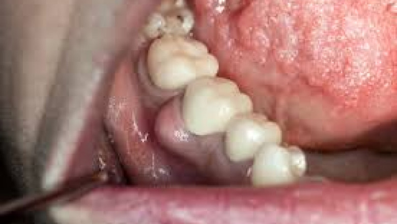 What Are the Significant Symptoms of a Tooth Infection Spreading to the Rest of the Body?