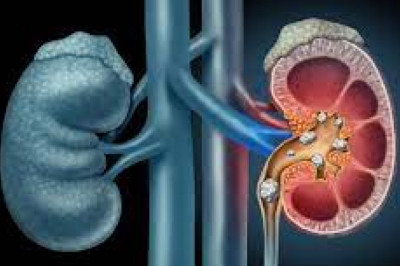 Cystinuria Treatment Market 2022 Major Key Players and Industry Analysis Till 2028