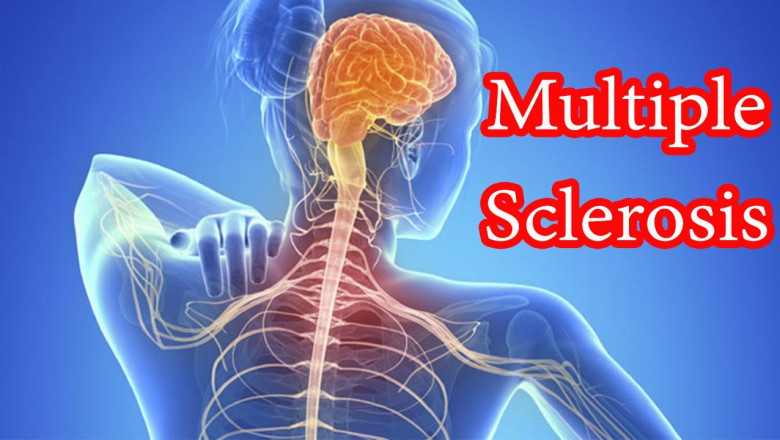 Multiple Sclerosis Therapeutics, physical therapy, and rehabilitation are all part of MS Therapeutics
