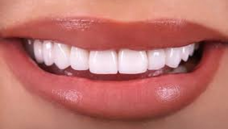 Recognizing The Essentials of Composite Dental Veneers