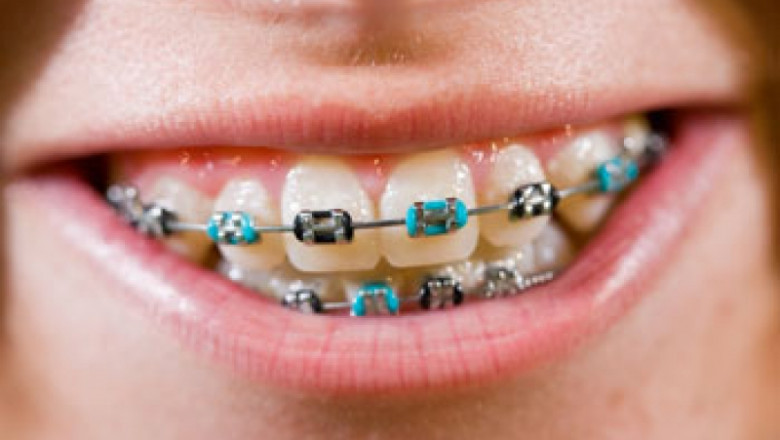 How Do You Know What Braces Colors To Get?