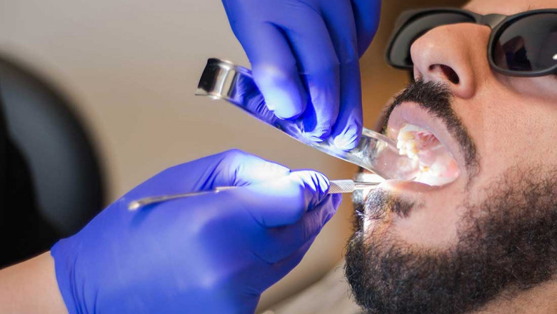 What Happens During A Root Canal Treatment?