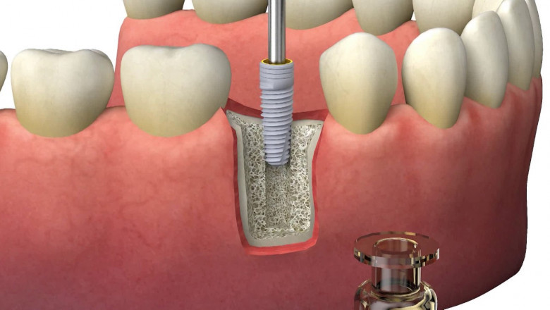 An organism or organisms that collaborate to increase soil fertility are known as bio-implants.