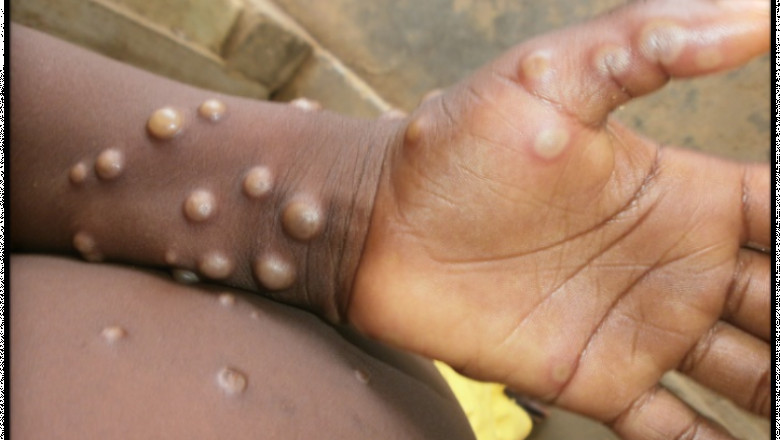 Monkeypox Outbreak: Causes, Symptoms and Prevention