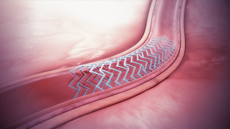 Bioabsorbable Stents Market Emerging Trends, Growth 2030