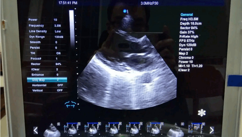 What Is A Color Doppler Ultrasound System