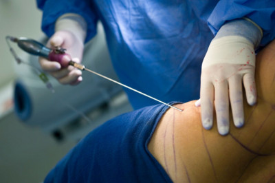 Why Not To Have A Traditional Liposuction