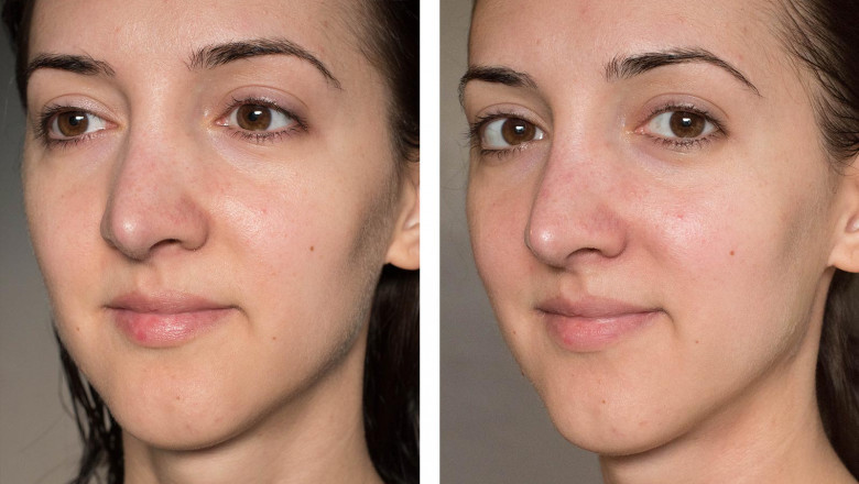 Pigmented Lesion Treatment Can Develop As A Result Of Photo-Damage, Which Is Prolonged Exposure To Ultraviolet (Uv) Light