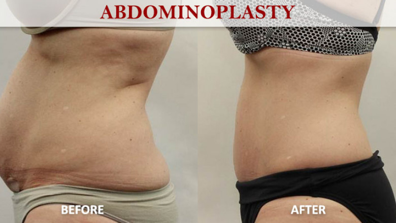 What is abdominoplasty and why is it performed?