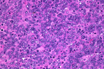 What happens if I am overexposed to formaldehyde?