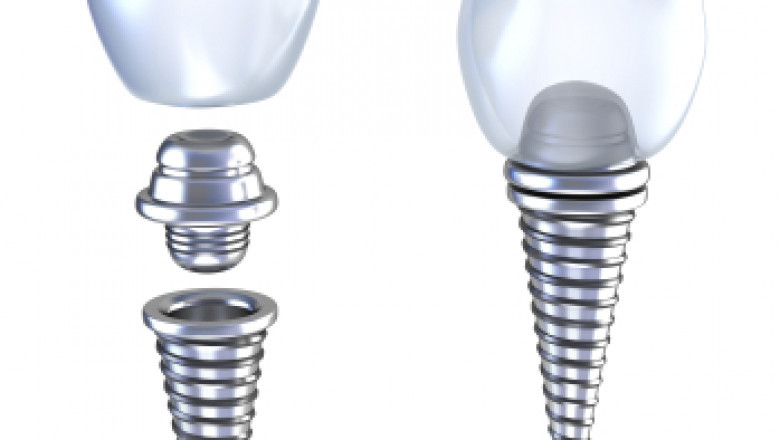 What is a Dental Crown?