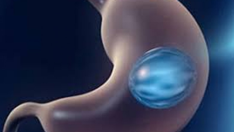 Intragastric Balloon Market Size, Share, Growth, Opportunities and Global Forecast to 2028