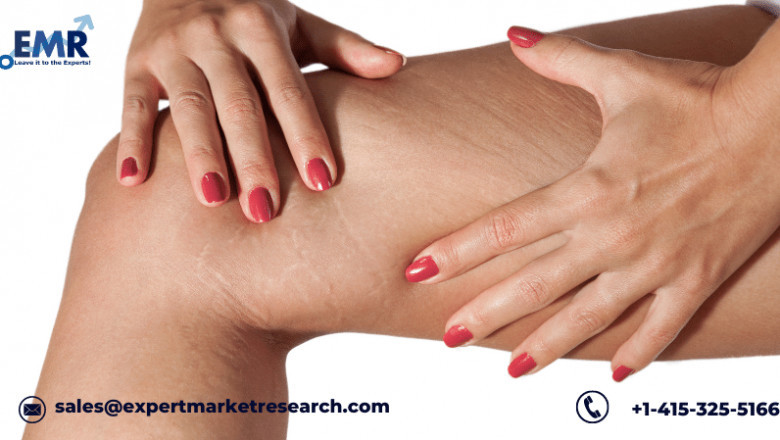 Global Stretch Marks Treatment Market To Be Driven By Increasing Prevalence Of Obesity Among The Population In The Forecast Period Of 2021-2026