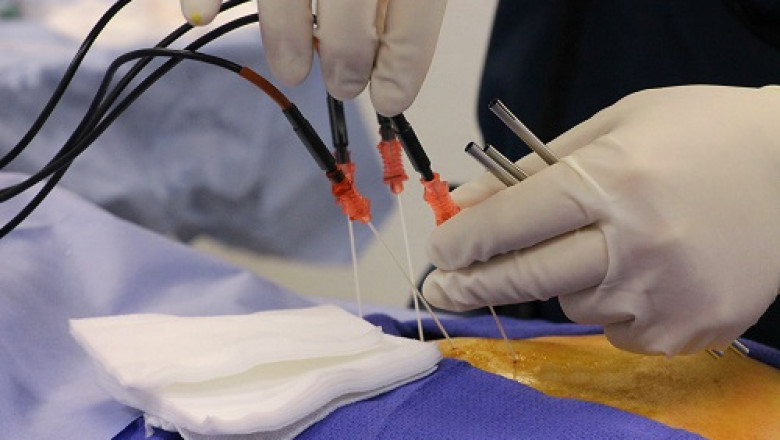 Image guided technology is one example of tumor ablation devices