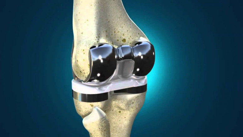 A Knee Implants Is Generally Made Up Of Ceramic Material, Metal Alloys, Or Strong Plastics