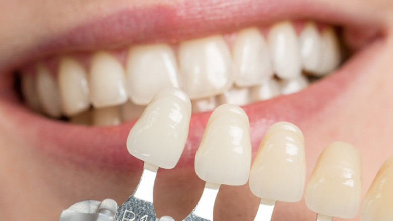 Aligners Have Come a Long Way from Being Uncomfortable to Being Invisible