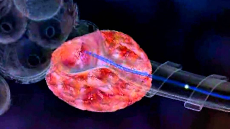 Global Brachytherapy Market Geographically Analysis