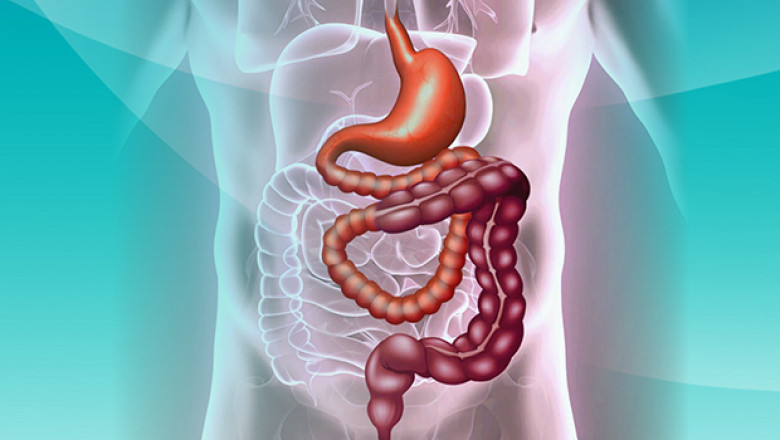 People With Generally Develop Short Bowel Syndrome. Had All Or A Portion Of Their Large Intestine Removed