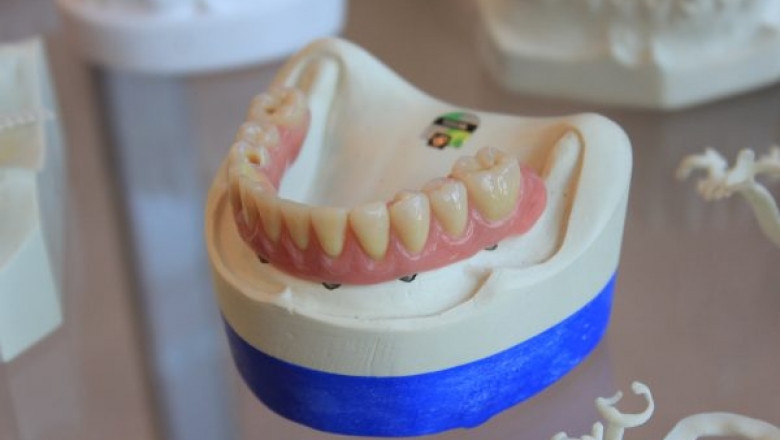 What Do Teeth Look Like Under Veneers?