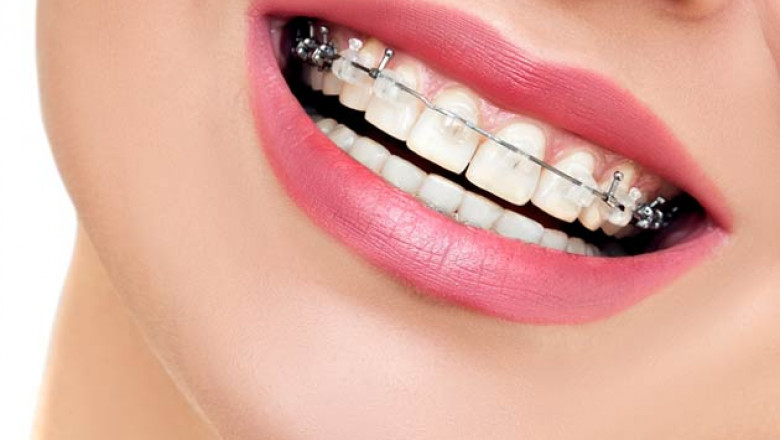 What Exactly Are Dental Braces?