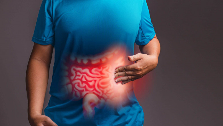 Crohn's disease - Unani Medication For Inflammation Bowel Diseases?