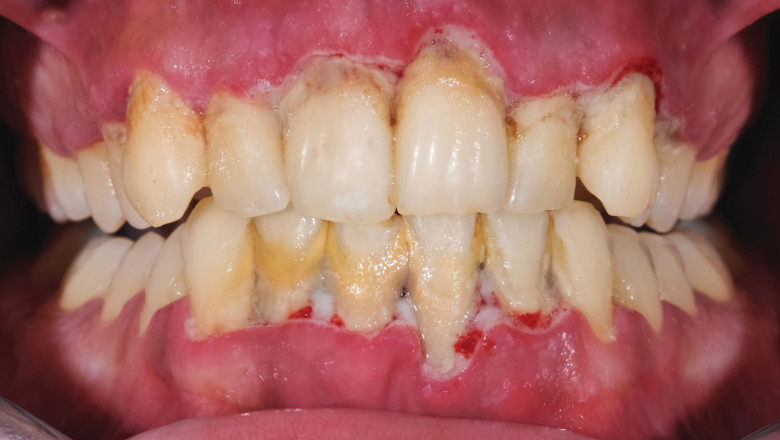 How Long Will Your Face Be Swollen And In Pain After A Root Canal?