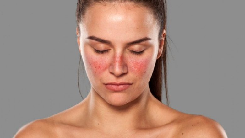 A Doctor May Prescribe Systemic Lupus Erythematosus Treatments If The Kidneys Aren't Working Properly