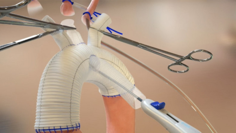 Blood Vessel Prosthesis Market 2022 Major Key Players and Industry Analysis Till 2028