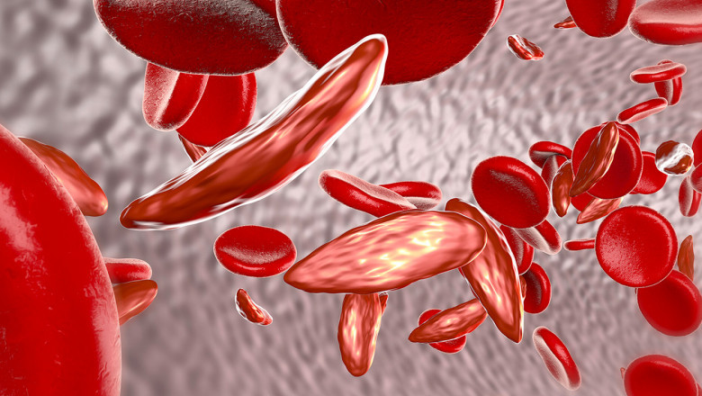 Execution of Sickle Cell Anemia Therapeutics
