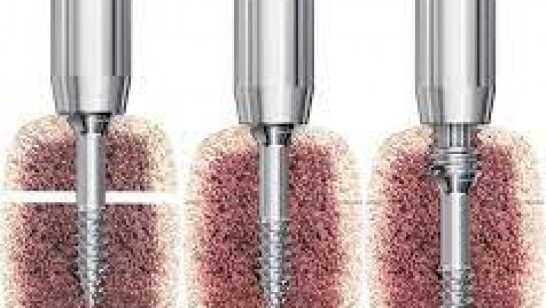 Global Headless Compression Screws Market 2022 - Top Key Players Analysis Report Till 2028