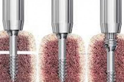 Global Headless Compression Screws Market 2022 - Top Key Players Analysis Report Till 2028