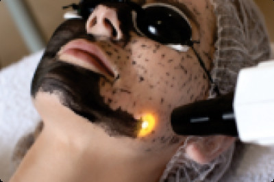 Laser Blackout Peel Facial | Laser Skin Rejuvenation