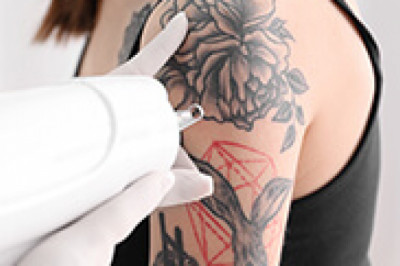 Laser Tattoo Removal | Musk