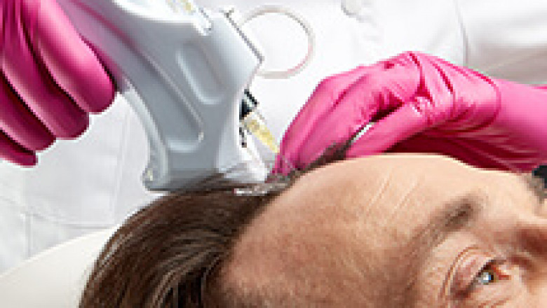 PRP Treatment in Ahmedabad, Best PRP Hair Loss Treatment In India