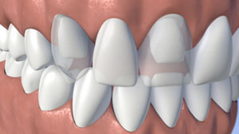 Why you should investigate dental inserts