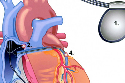 Cardiac Resynchronization Therapy Devices Market 2022 Size, Dynamics & Forecast Report to 2028
