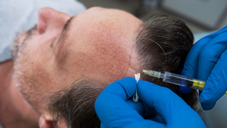 Hair Fall Treatment at No-Cost EMI in Indore