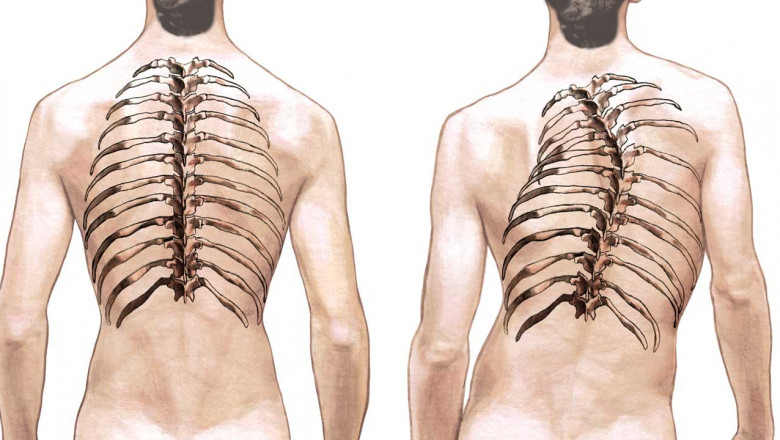 Global Adult Spinal Deformity Market Regional Insights