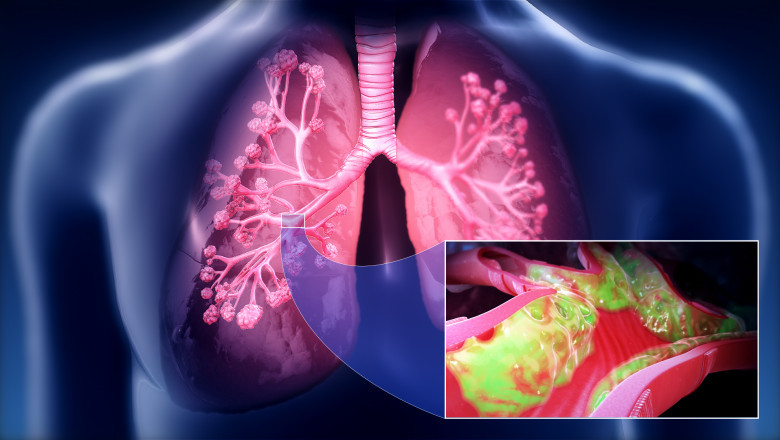 Global Pulmonary Edema Therapeutics Market Overview