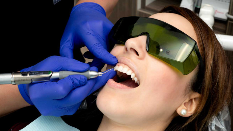 What is Dental Bonding?