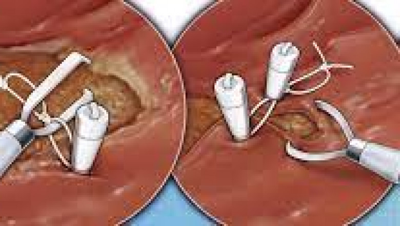 Endoscopic Clip Market Size, Key Players Analysis And Forecast To 2028 | Value Market Research