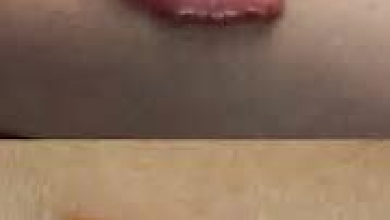 Hypertrophic And Keloid Scar Treatment Market 2022 New Opportunities, Dynamics With Financial Facts By 2028