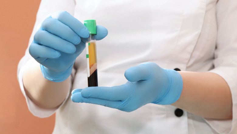 The Use Of Platelet Rich Plasma For Treating Tendon Injuries, Cartilage Damage, Bone Diseases Is On The Rise